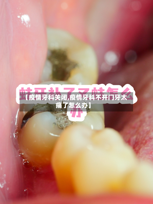 【疫情牙科关闭,疫情牙科不开门牙太痛了怎么办】-第3张图片