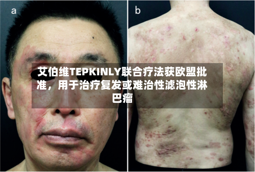 艾伯维TEPKINLY联合疗法获欧盟批准，用于治疗复发或难治性滤泡性淋巴瘤-第3张图片