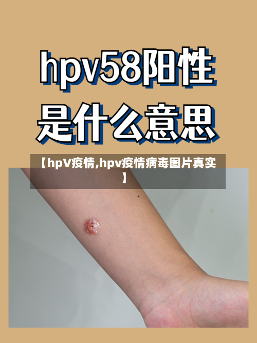 【hpV疫情,hpv疫情病毒图片真实】
