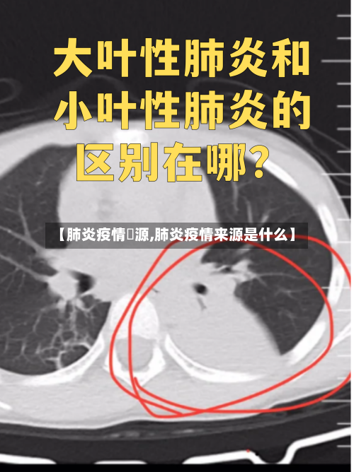 【肺炎疫情來源,肺炎疫情来源是什么】